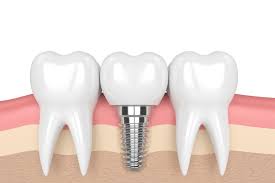 Dental Implants