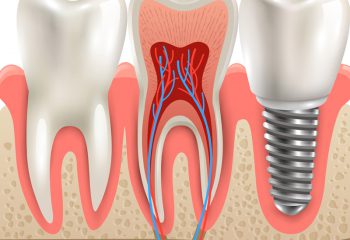 Root Canal Therapy