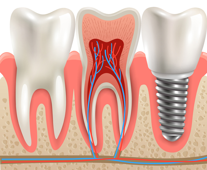 Root Canal Therapy